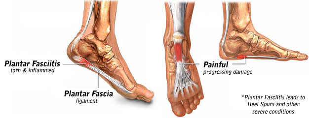 plantar_fasciitis