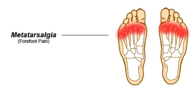 Metatarsalgia