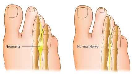 Neuroma